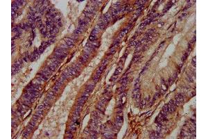 IHC image of ABIN7142882 diluted at 1:400 and staining in paraffin-embedded human colon cancer performed on a Leica BondTM system.