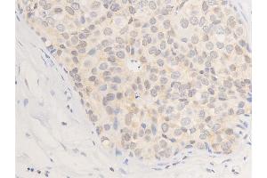 Immunohistochemistry (IHC) image for anti-Receptor tyrosine-protein kinase erbB-2 (ErbB2/Her2) (pTyr877) antibody (ABIN6256054)