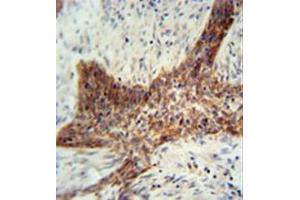 Formalin fixed, paraffin embedded human lung carcinoma stained with RILPL2 Antibody (Center) followed by peroxidase conjugation of the secondary antibody and DAB staining.
