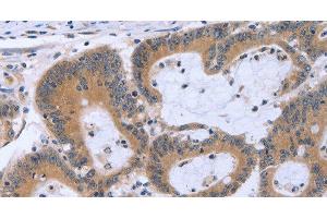 Immunohistochemistry of paraffin-embedded Human colon cancer using MAPRE3 Polyclonal Antibody at dilution of 1:30 (ECE1 抗体)