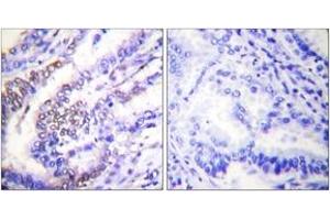 Immunohistochemistry analysis of paraffin-embedded human lung carcinoma tissue, using Cyclin E1 Antibody. (Cyclin E1 抗体  (AA 91-140))