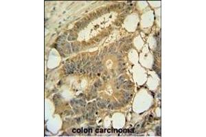 EPS8L3 Antibody (N-term) (ABIN390898 and ABIN2841105) immunohistochemistry analysis in formalin fixed and paraffin embedded human colon carcinoma followed by peroxidase conjugation of the secondary antibody and DAB staining. (EPS8-Like 3 抗体  (N-Term))