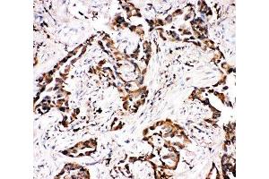 IHC-P: APLP1 antibody testing of human lung cancer tissue (APLP1 抗体  (N-Term))