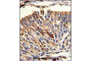 Formalin-fixed and paraffin-embedded human lung carcinoma with VTI1A Antibody (C-term), which was peroxidase-conjugated to the secondary antibody, followed by DAB staining. (VTI1A 抗体  (C-Term))