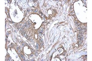 IHC-P Image Immunohistochemical analysis of paraffin-embedded human gastric cancer, using S100A10, antibody at 1:500 dilution. (S100A10 抗体)