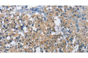 Immunohistochemistry of paraffin-embedded Human thyroid cancer tissue using BMPR1B Polyclonal Antibody at dilution 1:30 (BMPR1B 抗体)