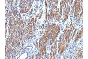 Formalin-fixed, paraffin-embedded human Leiomyosarcoma stained with SM-MHC Monoclonal Antibody (SMMS-1). (MYH11 抗体)