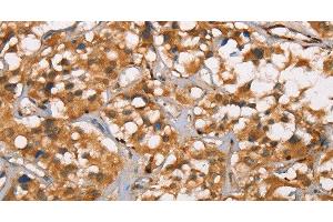 Immunohistochemistry of paraffin-embedded Human thyroid cancer tissue using DICER1 Polyclonal Antibody at dilution 1:40 (DICER1 抗体)