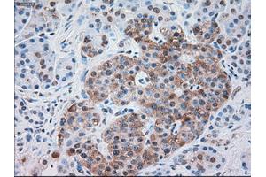 Immunohistochemical staining of paraffin-embedded Carcinoma of kidney tissue using anti-SERPINA1mouse monoclonal antibody. (SERPINA1 抗体)