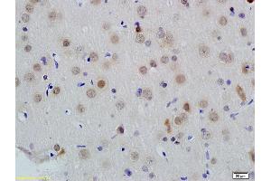 Formalin-fixed and paraffin embedded human colon carcinoma labeled with Anti-ID1 Polyclonal Antibody, Unconjugated (ABIN700330) at 1:200 followed by conjugation to the secondary antibody and DAB staining (ID1 抗体  (AA 51-155))