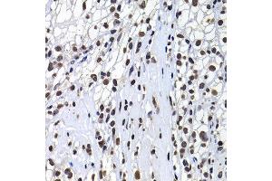 Immunohistochemistry of paraffin-embedded human kidney cancer using H2AFY antibody at dilution of 1:100 (x400 lens). (H2AFY 抗体)