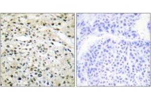 Immunohistochemistry analysis of paraffin-embedded human liver carcinoma tissue, using DNMT3B Antibody. (DNMT3B 抗体  (AA 1-50))