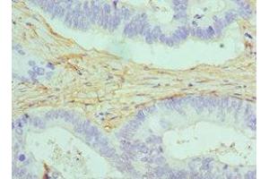 Immunohistochemistry of paraffin-embedded human colon cancer using ABIN7146462 at dilution of 1:100 (Caldesmon 抗体  (AA 1-240))