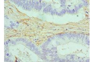 Immunohistochemistry of paraffin-embedded human colon cancer using ABIN7146462 at dilution of 1:100 (Caldesmon 抗体  (AA 1-240))