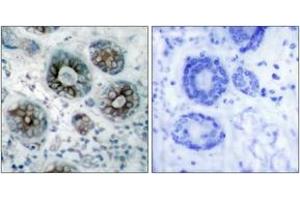 Immunohistochemistry analysis of paraffin-embedded human breast carcinoma tissue, using GAP43 (Ab-41) Antibody. (GAP43 抗体  (AA 8-57))