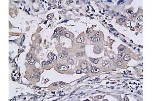 Formalin-fixed and paraffin embedded human colon cancer labeled with Anti-TRAILR2/DR5/CD262 Polyclonal Antibody, Unconjugated (ABIN733118) followed by conjugation to the secondary antibody and DAB staining (TNFRSF10B 抗体  (AA 301-381))