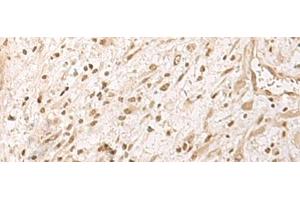 Immunohistochemistry of paraffin-embedded Human ovarian cancer tissue using RRP1 Polyclonal Antibody at dilution of 1:45(x200) (RRP1 抗体)