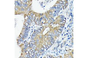 Immunohistochemistry of paraffin-embedded human colon carcinoma using DR5/TR/TNFRSF10B Rabbit mAb (ABIN7271062) at dilution of 1:100 (40x lens).