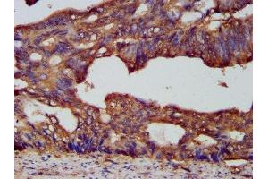 IHC image of ABIN7164828 diluted at 1:200 and staining in paraffin-embedded human colon cancer performed on a Leica BondTM system. (PCSK7 抗体  (AA 189-362))