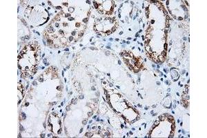 Immunohistochemical staining of paraffin-embedded Carcinoma of prostate tissue using anti-LIPG mouse monoclonal antibody. (LIPG 抗体)