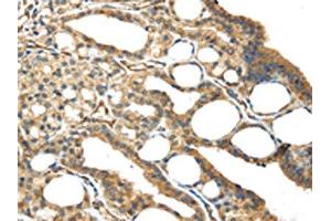 The image on the left is immunohistochemistry of paraffin-embedded Human thyroid cancer tissue using ABIN7191125(ISM2 Antibody) at dilution 1/45, on the right is treated with synthetic peptide. (Isthmin 2 抗体)