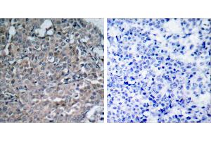 Peptide - +Immunohistochemical analysis of paraffin-embedded human breast carcinoma tissue using FAK (Ab-925) antibody (#B7083).