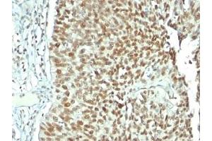 Formalin-fixed, paraffin-embedded human bladder carcinoma stained with Nucleolin antibody. (Nucleolin 抗体)