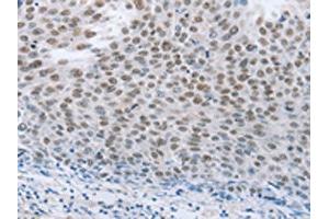 The image on the left is immunohistochemistry of paraffin-embedded Human liver cancer tissue using ABIN7191633(NEUROG2 Antibody) at dilution 1/15, on the right is treated with synthetic peptide. (Neurogenin 2 抗体)