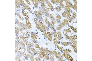 Immunohistochemistry of paraffin-embedded human liver damage using TOB2 antibody (ABIN6128831, ABIN6149377, ABIN6149378 and ABIN6223057) at dilution of 1:100 (40x lens). (TOB2 抗体  (AA 1-70))