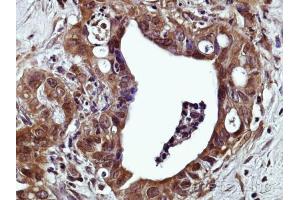 IHC-P Image Immunohistochemical analysis of paraffin-embedded Human prostate adenocarcinoma, using GPR120 , antibody at 1:500 dilution. (O3FAR1 抗体  (N-Term))