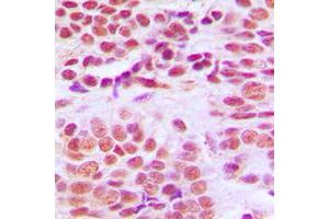Immunohistochemical analysis of Histone Deacetylase 1 staining in human breast cancer formalin fixed paraffin embedded tissue section.