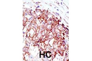 Formalin-fixed and paraffin-embedded human hepatocellular carcinoma tissue reacted with MIB1 polyclonal antibody  , which was peroxidase-conjugated to the secondary antibody, followed by AEC staining. (MIB1 抗体  (N-Term))