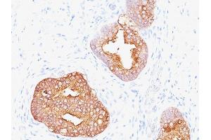 Formalin-fixed, paraffin-embedded human Prostate Carcinoma stained with Prostate Specific Antigen Mouse Monoclonal Antibody (1A7). (Prostate Specific Antigen 抗体)