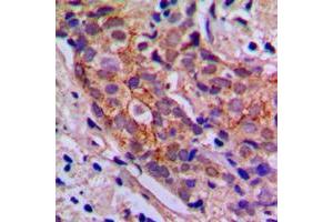 Immunohistochemical analysis of PI3K p85 alpha/p55 gamma staining in human breast cancer formalin fixed paraffin embedded tissue section. (PIK3R3 抗体  (Center))