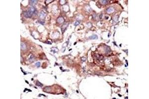 IHC analysis of FFPE human breast carcinoma tissue stained with the MUSK antibody (MUSK 抗体  (AA 829-859))