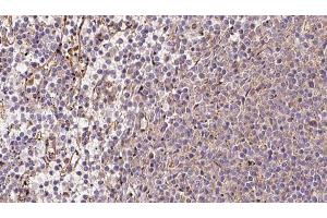 ABIN6273216 at 1/100 staining Human lymph cancer tissue by IHC-P. (CRAT 抗体  (N-Term))