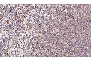 ABIN6273216 at 1/100 staining Human lymph cancer tissue by IHC-P.