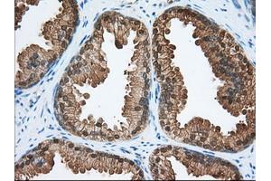 Immunohistochemical staining of paraffin-embedded Adenocarcinoma of Human colon tissue using anti-ACAT2 mouse monoclonal antibody. (ACAT2 抗体)