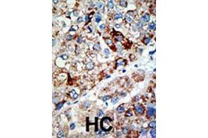 Formalin-fixed and paraffin-embedded human hepatocellular carcinoma tissue reacted with USP21 polyclonal antibody , which was peroxidase-conjugated to the secondary antibody, followed by AEC staining. (USP21 抗体  (N-Term))