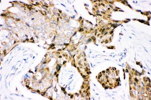 Anti- Ubiquitin Picoband antibody, IHC(P) IHC(P): Human Mammary Cancer Tissue (Ubiquitin B 抗体  (AA 77-152))