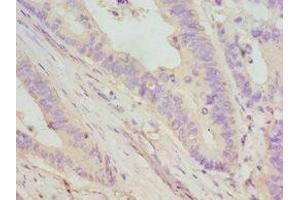 Immunohistochemistry of paraffin-embedded human colon cancer using ABIN7149695 at dilution of 1:100 (DMP1 抗体  (AA 254-513))
