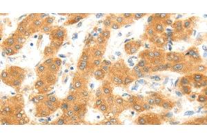 Immunohistochemistry of paraffin-embedded Human liver cancer using MAP2K6 Polyclonal Antibody at dilution of 1:30 (MAP2K6 抗体)