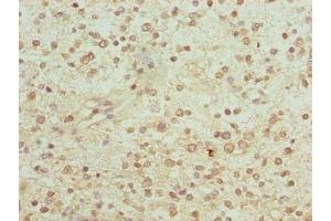 Immunohistochemistry of paraffin-embedded human glioma using ABIN7153904 at dilution of 1:100 (PGM2L1 抗体  (AA 101-400))