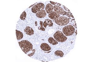 Skin Malignant melanoma with strong Melan A positivity in all tumor cells (Recombinant MLANA 抗体)