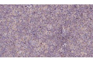 ABIN6273145 at 1/100 staining Human lymph cancer tissue by IHC-P. (NDUFS7 抗体  (Internal Region))