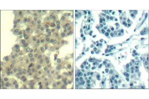 Immunohistochemical analysis of paraffin-embedded human breast carcinoma tissue using Her3/ErbB3 (Ab-1328) Antibody (E021510). (ERBB3 抗体)