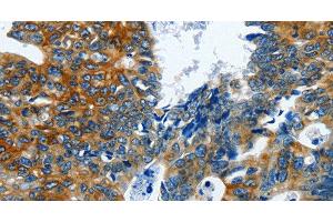 Immunohistochemistry of paraffin-embedded Human colon cancer using BPIFB3 Polyclonal Antibody at dilution of 1:120 (BPIFB3 抗体)