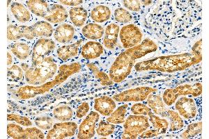ABIN6263283 and ABIN6273140 at 1/100 staining Human kidney cancer and adjacent normal tissues by IHC-P.