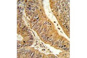 Formalin-fixed, paraffin-embedded human colon carcinoma reacted with CXXC4 Antibody (C-term), which was peroxidase-conjugated to the secondary antibody, followed by DAB staining. (CXXC4 抗体  (C-Term))