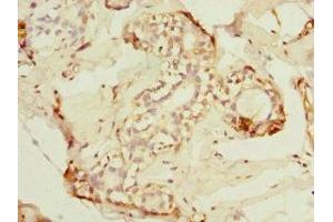 Immunohistochemistry of paraffin-embedded human breast cancer using ABIN7143282 at dilution of 1:100 (ADAD1 抗体  (AA 1-280))
